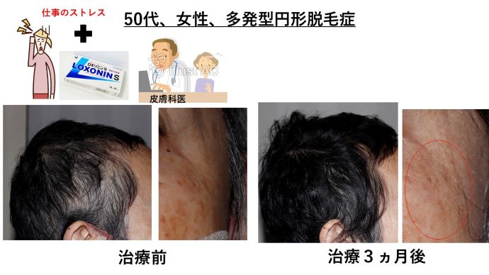 円形脱毛症　病院